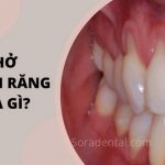 Hở chân răng là gì? Khắc phục như thế nào?