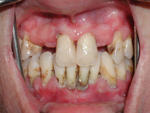 Hở chân răng nếu không điều trị sẽ gây mất răng