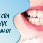 Hở răng cửa nguyên nhân và cách khắc phục như thế nào?