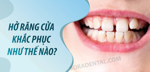 Hở răng cửa khắc phục như thế nào?