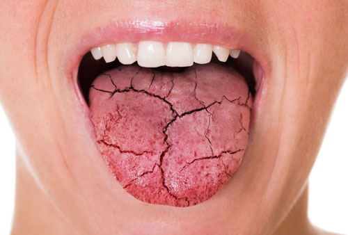 Khô miệng tạo điều kiện cho vi khuẩn phát triển gây đắng miệng