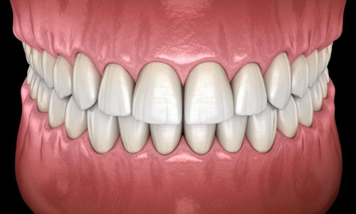 Khớp cắn chuẩn khi nhóm răng hàm khít vào nhau và nhóm răng cửa hàm trên ôm lấy nhóm răng cửa hàm dưới