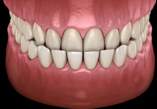 Khớp cắn ngược là tình trạng răng hàm dưới chìa ra ngoài và bao phủ răng hàm trên