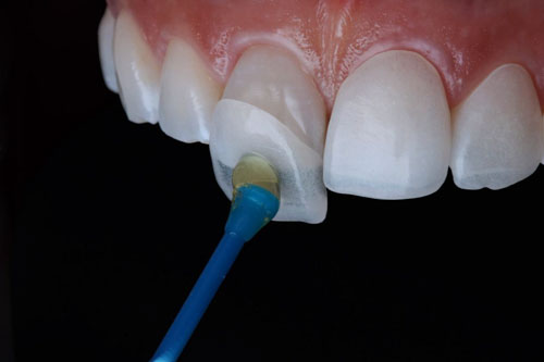 Làm răng thỏ bằng phương pháp dán sứ Veneer giúp hạn chế việc mài răng