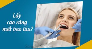 Lấy cao răng mất bao lâu?