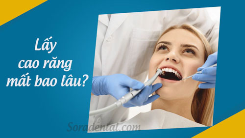 Lấy cao răng mất bao lâu?