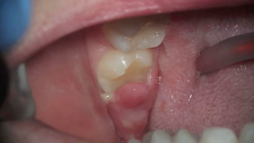 Lợi trùm là tình trạng phổ biến khi mọc răng khôn