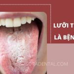 Lưỡi trắng là gì? Nguyên nhân và cách điều trị