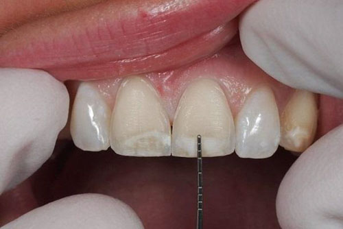 Mặt dán sứ có tỷ lệ mài răng cực ít