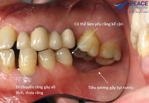 Mất răng gây ảnh hưởng nhiều đến các răng còn lại