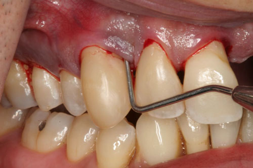 Mất răng làm tăng nguy cơ bị viêm nướu, viêm nha chu