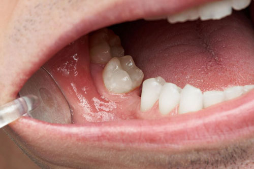Mất răng sớm khiến răng xô lệch cũng là nguyên nhân gây loạn khớp hàm
