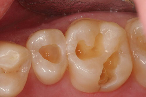 Mẻ răng hàm khiến cấu trúc bảo vệ răng bị tổn thương