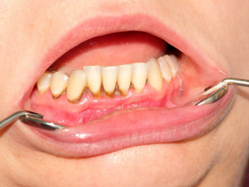 Mức độ vôi răng sẽ ảnh hưởng đến thời gian cạo vội răng