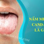 Nhiễm nấm Candida miệng