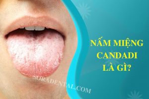 Read more about the article Nhiễm nấm Candida miệng