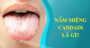 Nấm miệng Candida là gì?