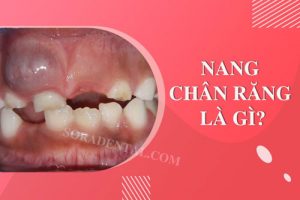 Read more about the article Nang chân răng là gì? Cách điều trị nang chân răng
