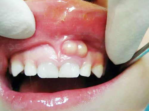 Nang chân răng là một dạng viêm nhiễm ở chân răng