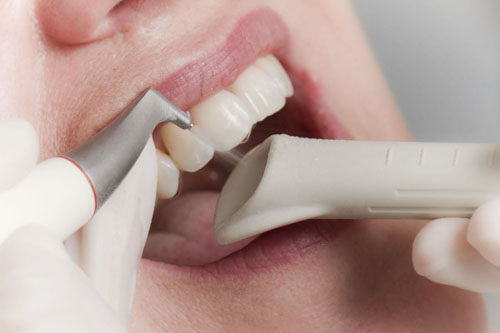 Nên cạo vôi răng định kỳ 3 - 6 tháng/lần theo hướng dẫn của nha sĩ