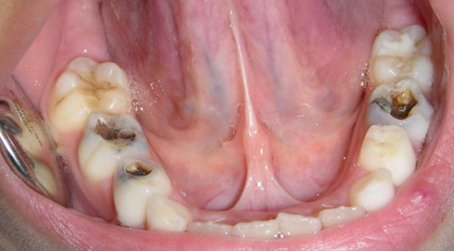 Răng bị vỡ mẻ có thể là do sâu răng gây ra