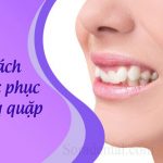 Cách khắc phục răng quặp hiệu quả