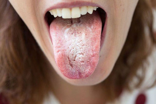 Nhiễm nấm Candida khiến họng bị đau khi nuốt nước bọt