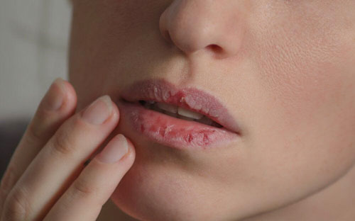 Nhiễm nấm Candida với biểu hiện là nóng rát miệng và những mảng trắng trên lưỡi môi