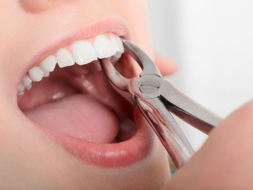 Nhổ răng khểnh là một tiểu phẫu đơn giản