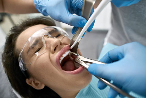 Nhổ răng trong trường hợp răng bị nứt nghiêm trọng