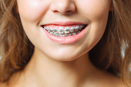 Niềng răng giúp cải thiện tình trạng cười hở lợi