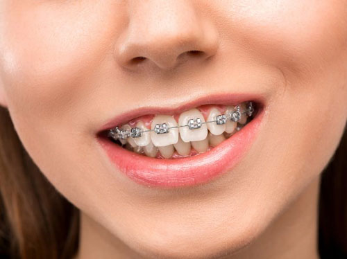 Niềng răng giúp cải thiện tình trạng sai khớp cắn