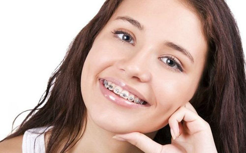 Niềng răng giúp khắc phục tình trạng móm
