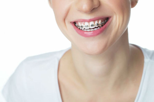 Niềng răng là giải pháp tối ưu giúp khắc phục răng quặp