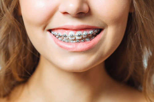 Niềng răng là một trong những giải pháp giúp khắc phục loạn khớp hàm