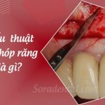 Phẫu thuật cắt chóp răng là gì? Có nguy hiểm không?