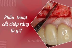Read more about the article Phẫu thuật cắt chóp răng là gì? Có nguy hiểm không?