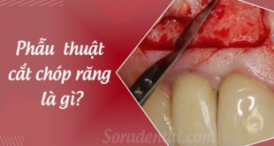 Phẫu thuật cắt chóp răng