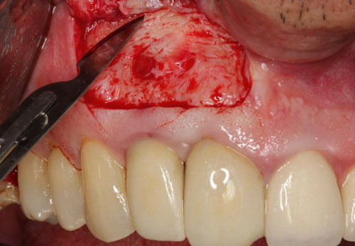 Phẫu thuật cắt chóp răng không gây nguy hiểm nếu thực hiện tại nha khoa uy tín