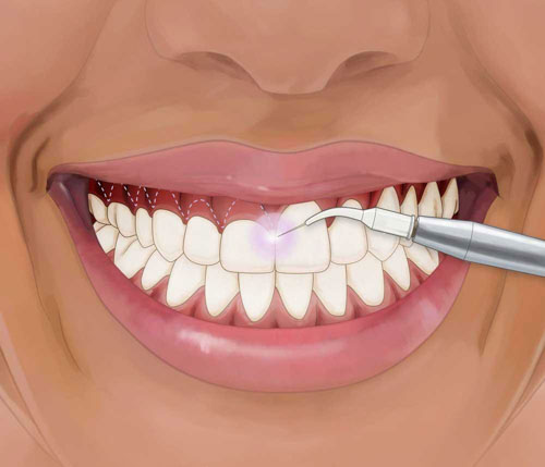 Phẫu thuật cắt nướu là một trong những giải pháp khắc phục tình trạng cười hở lợi