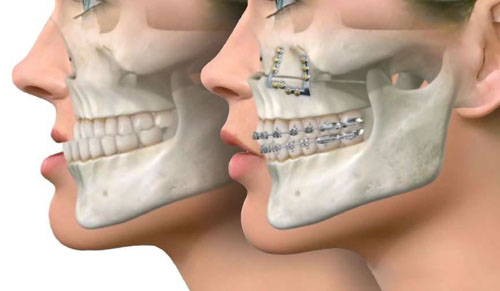 Phẫu thuật hàm kết hợp với niềng răng khắc phục khớp cắn ngược