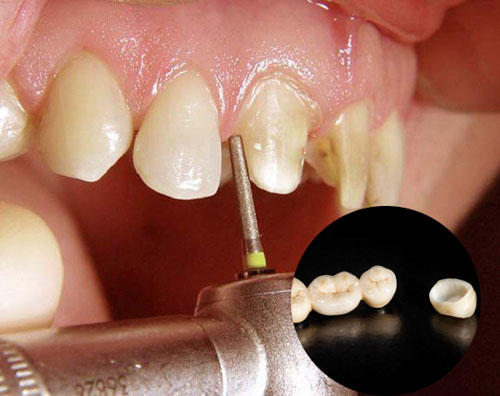 Phương pháp bọc răng sứ làm răng khểnh