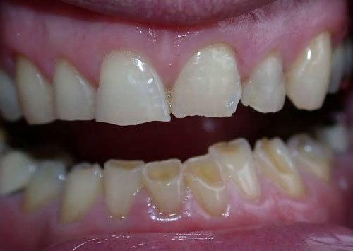 Răng bị mòn do ảnh hưởng của việc nghiến răng