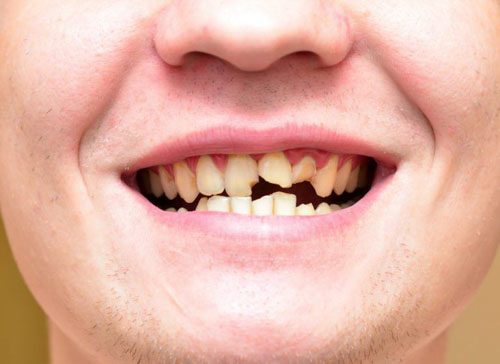Răng bị sứt mẽ, gãy vỡ thường nhạy cảm hơn so với bình thường