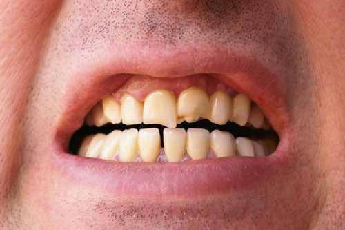 Răng bị sứt mẻ làm ảnh hưởng đến thẩm mỹ nụ cười