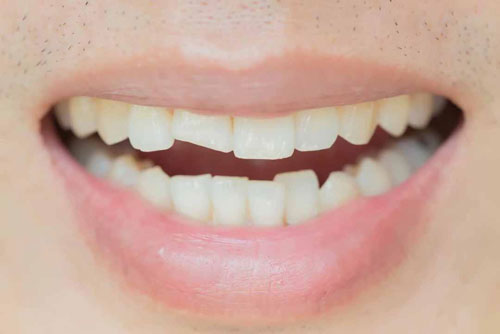 Răng bị sứt mẻ lớn gây tác động đến ngà răng