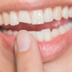 Răng bị vỡ phải làm sao để khắc phục?