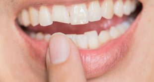 Răng vỡ phải làm sao để khắc phục?