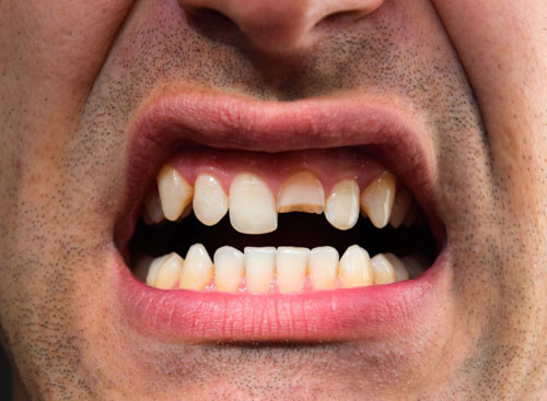 Răng cửa bị gãy lớn hơn 1/3 thân răng