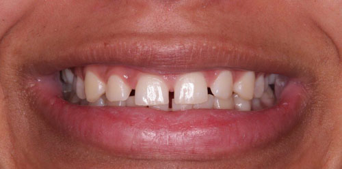 Răng cửa thưa do sự mất cân đối giữa cung hàm với kích thước răng